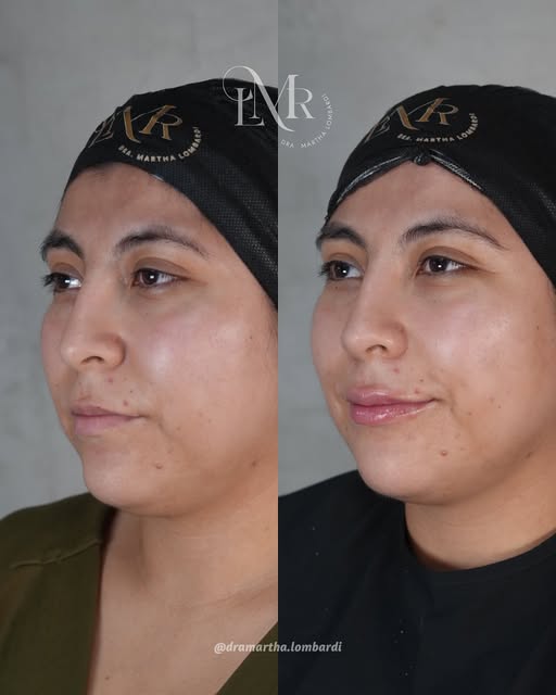 Antes y después de armonización de labios