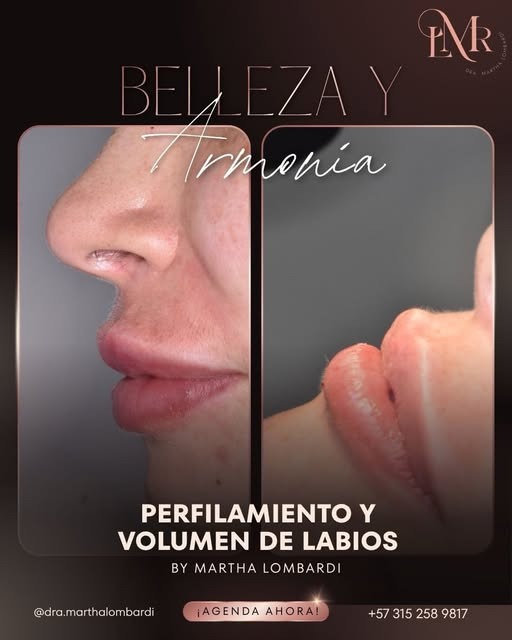Antes y después de perfilamiento y volumen de labios